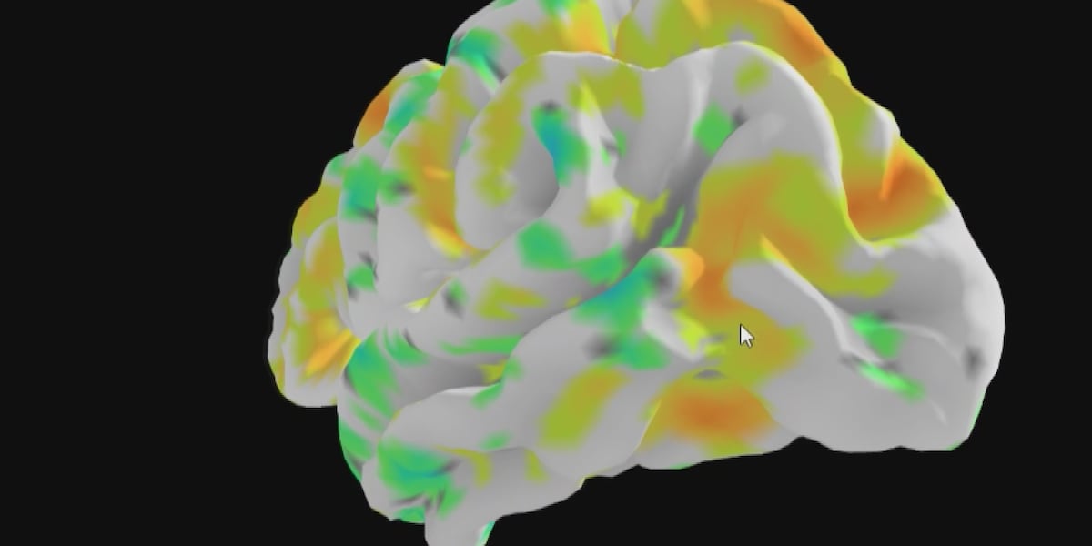 Memory Abnormal Mayo Clinic researchers define a new memory loss syndrome often ...